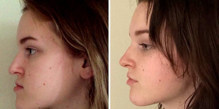 Jaw Aesthetic Surgery