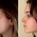 Jaw Aesthetic Surgery