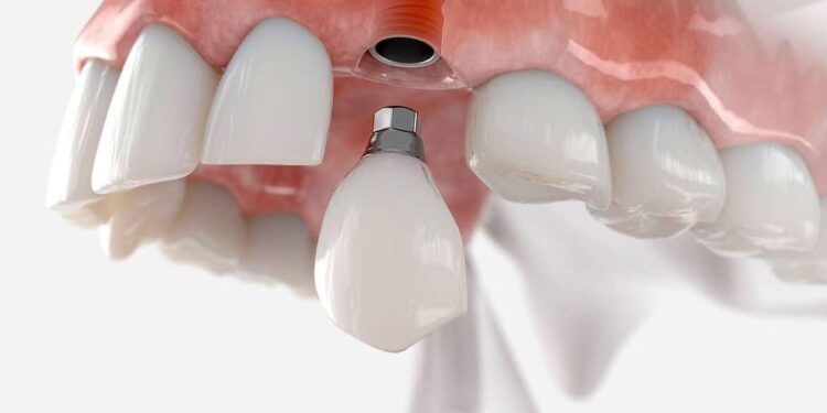 Dental Implants and Dentures