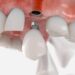 Dental Implants and Dentures