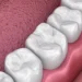 Dental Sealants