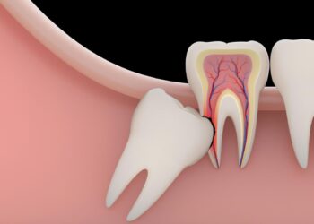Emergency Wisdom Tooth Extraction