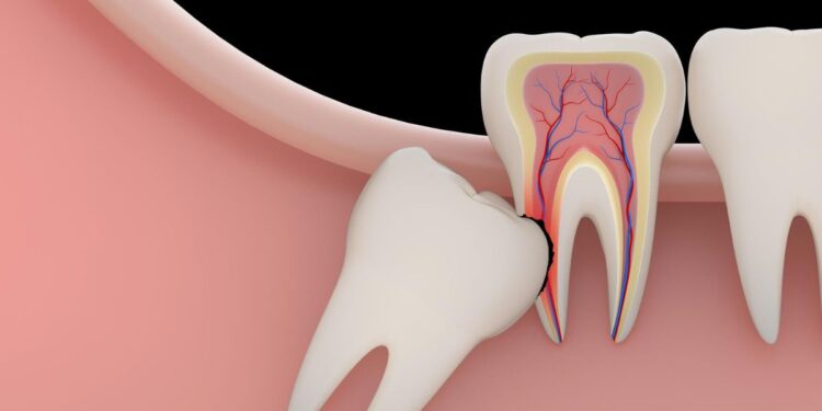 Emergency Wisdom Tooth Extraction