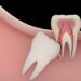 Emergency Wisdom Tooth Extraction