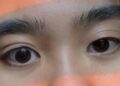 Eye Asymmetry
