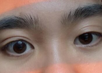 Eye Asymmetry