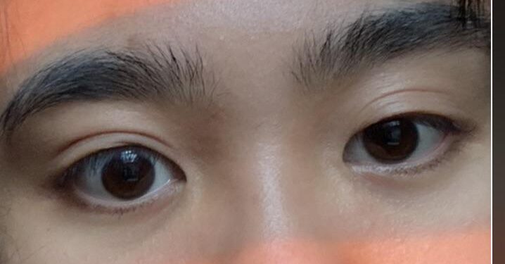 Eye Asymmetry