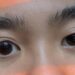 Eye Asymmetry