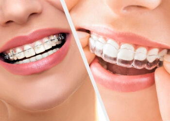 Invisalign vs Braces