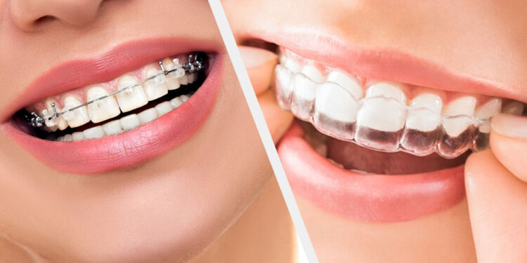 Invisalign vs Braces