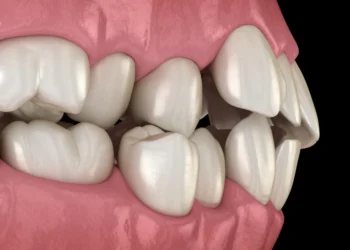Teeth Misalignment and Their Causes