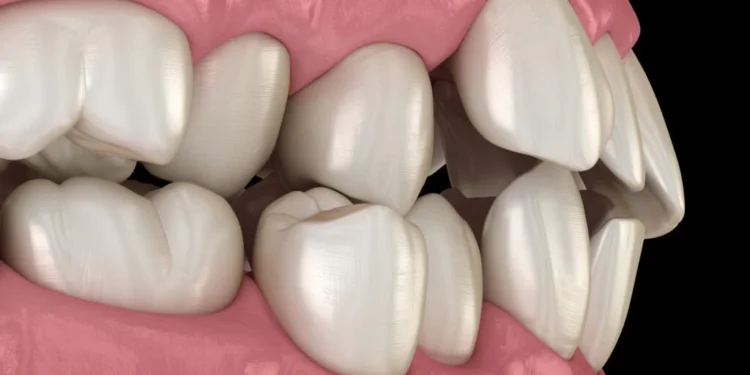 Teeth Misalignment and Their Causes