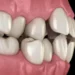 Teeth Misalignment and Their Causes