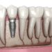 Tooth Implants