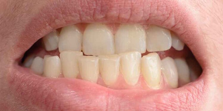 Top 6 Signs Your Teeth Are Shifting You Should Never Ignore