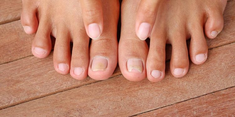 Hallux Limitus and Hallux Rigidus