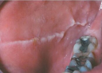 Linea Alba in Mouth: Causes, Symptoms, and Treatment