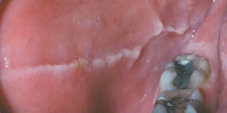 Linea Alba in Mouth: Causes, Symptoms, and Treatment