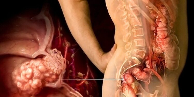 Anal Fissures and Cancer