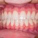 Early Signs of Gingivitis and Tooth Decay