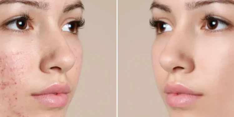 Eye Treatment & Acne Scar Removal