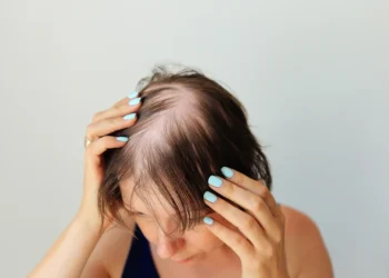Hair Loss in Women
