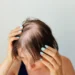Hair Loss in Women