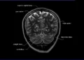 MRI Brain Anatomy