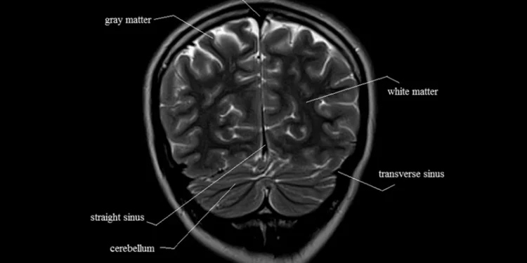 MRI Brain Anatomy