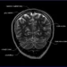 MRI Brain Anatomy