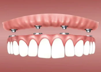 Cost of Full Mouth Dental Implants
