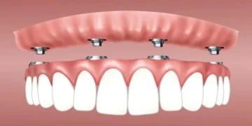 Cost of Full Mouth Dental Implants