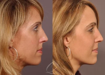 Facial Augmentation