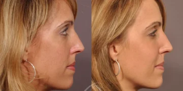 Facial Augmentation