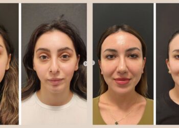 Facial Implants