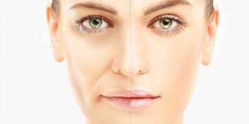 Facial Rejuvenation