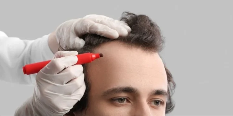 Hair Transplant Planning and Procedure