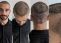 Hair Transplant Recovery Process
