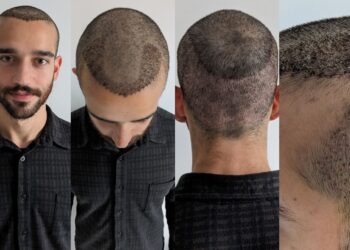 Hair Transplant Recovery Process