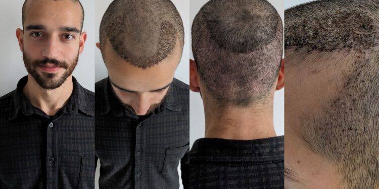 Hair Transplant Recovery Process