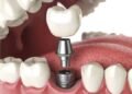 Restoring Everyday Comfort After Tooth Loss With Dental Implants