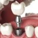 Restoring Everyday Comfort After Tooth Loss With Dental Implants
