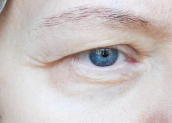 When Tired-Looking Eyes Are Actually a Structural Problem
