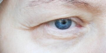 When Tired-Looking Eyes Are Actually a Structural Problem