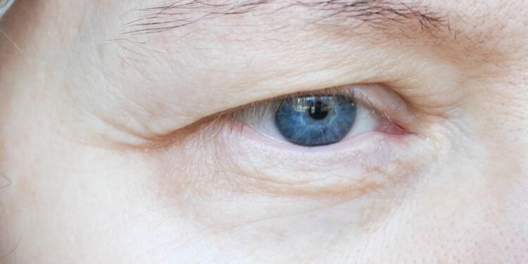 When Tired-Looking Eyes Are Actually a Structural Problem