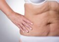 Recovering From Liposuction in Dubai's Climate: What Generic Advice Misses