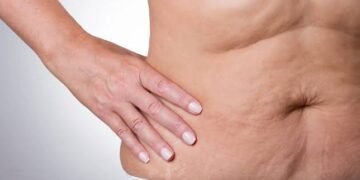 Recovering From Liposuction in Dubai's Climate: What Generic Advice Misses