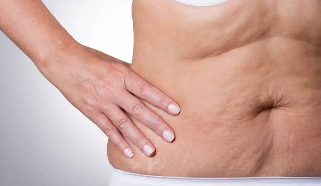 Recovering From Liposuction in Dubai's Climate: What Generic Advice Misses